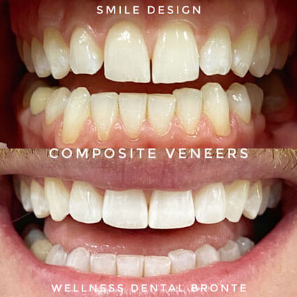 veneers gallery 2