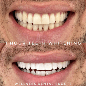 teeth whitening