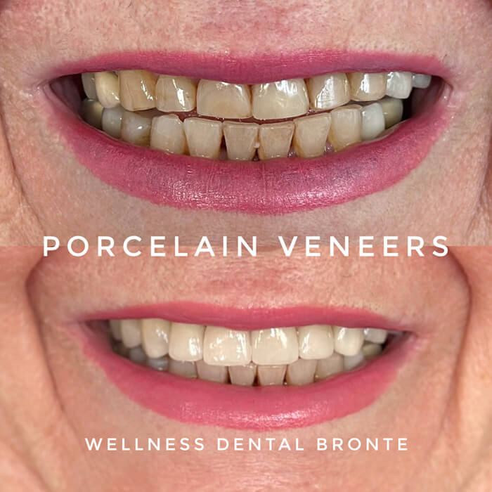 porcelain veneers before and after on older woman