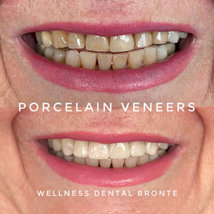 porcelain veneers befroe and after woman