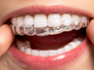 Woman with clear dental trays