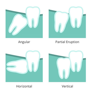 Illustration of wisdom teeth