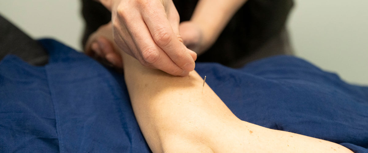 acupuncture in arm
