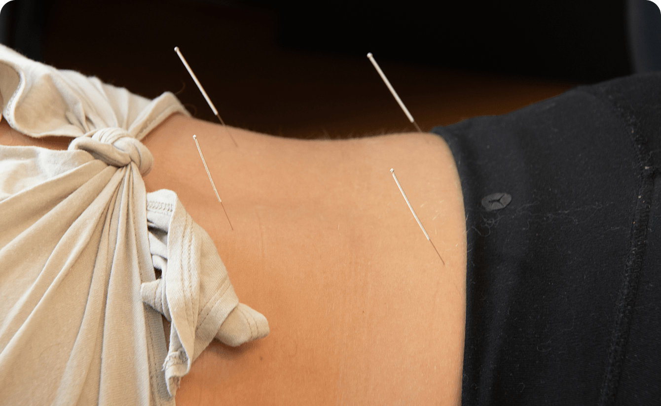 acupuncture needles in persons back