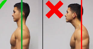 forward head posture before and after