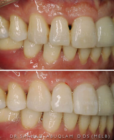 Comparison of bioclear on teeth