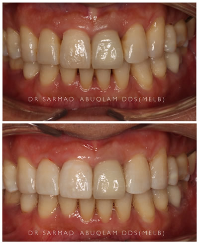 Bioclear Before and After-2