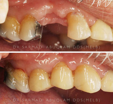 Before and After a bridge in teeth