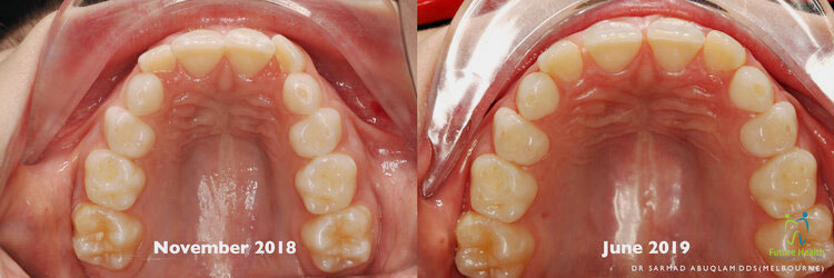 Comparison of teeth with expanders