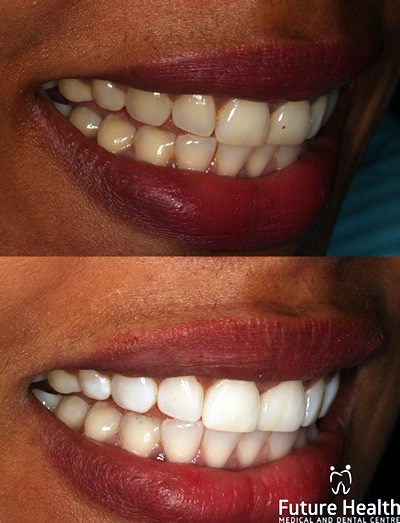 In office whitening before and after