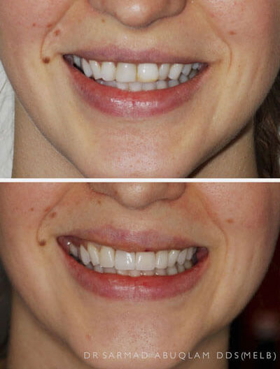 Before and after of veneers