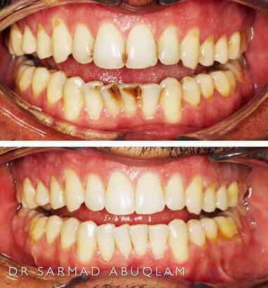 Before and After scale and clean