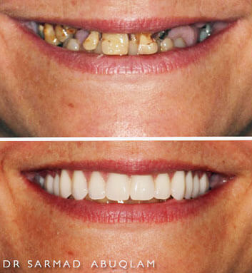 Before and After of a complete smile makeover