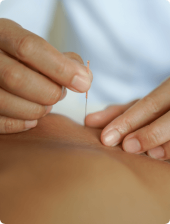 Victoria acupuncture