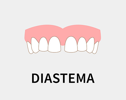 diastema