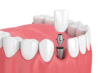 single-implant
