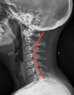 Cervical Radiograph