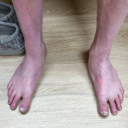 After Neuropathy Treatment