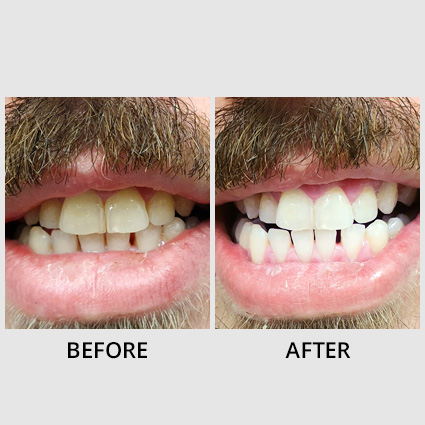 teeth whitening before and after comparison