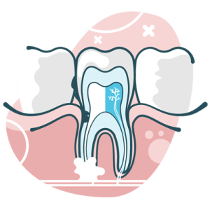 root canal illustration