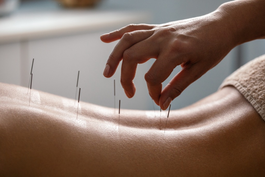 acupuncture-back-treatment.jpg_s=1024x1024&w=is&k=20&c=FKBMUChnGMuzTFgAjI3uxJTN4jL3JdtrE0JWcOjEVQU=