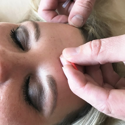 Needling on face