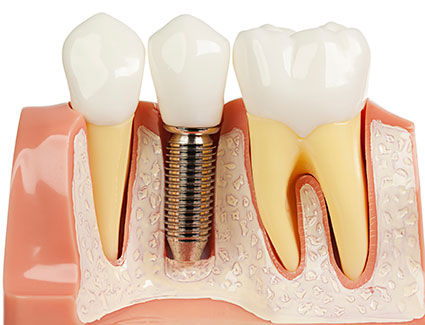 dental implant model