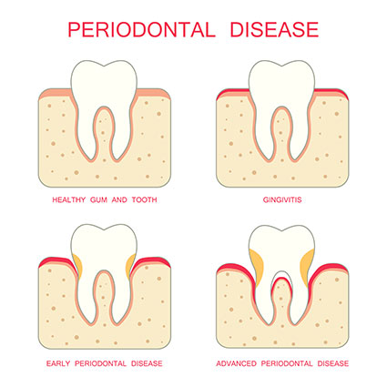 Gum disease illustration