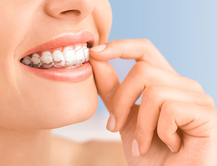 Woman putting in invisalign
