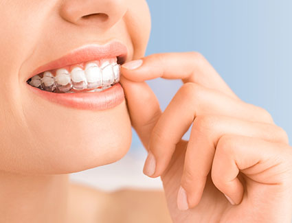 8 Clear Advantages of Invisalign Aligners - Doyle Orthodontics