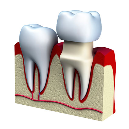 Porcelain crown model