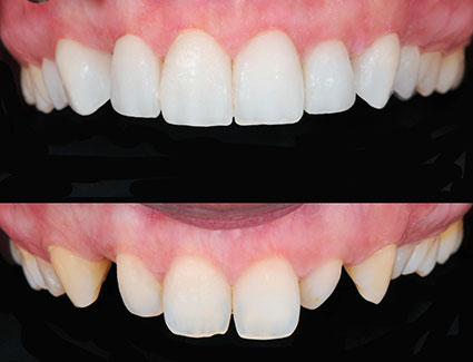 Porcelain veneers before and after