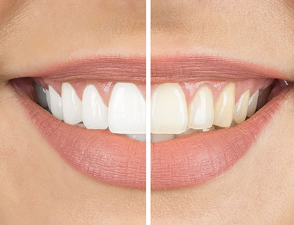 Before and after teeth whitening