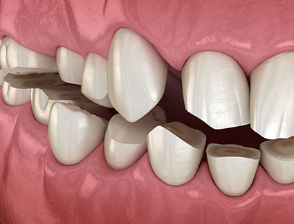 TMJ dysfunction model