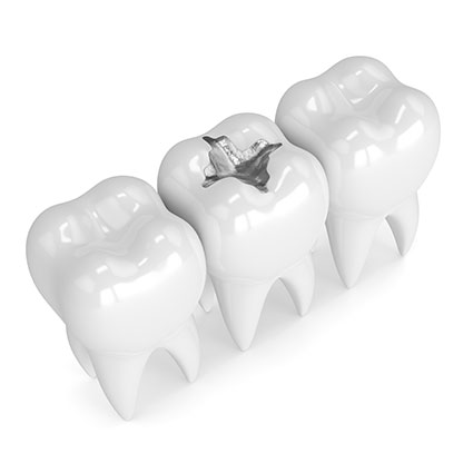 Tooth with filling model