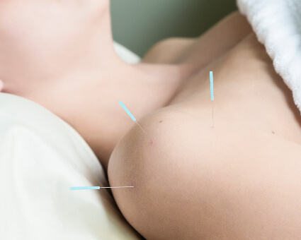 Acupuncture used to treat female patient