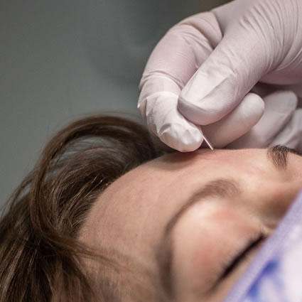 Acupuncture in forehead