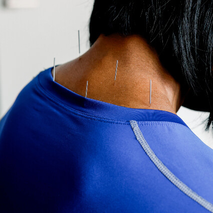 acupuncture needles on neck