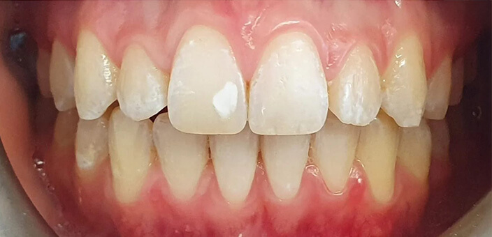 invisalign before