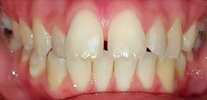 invisalign After