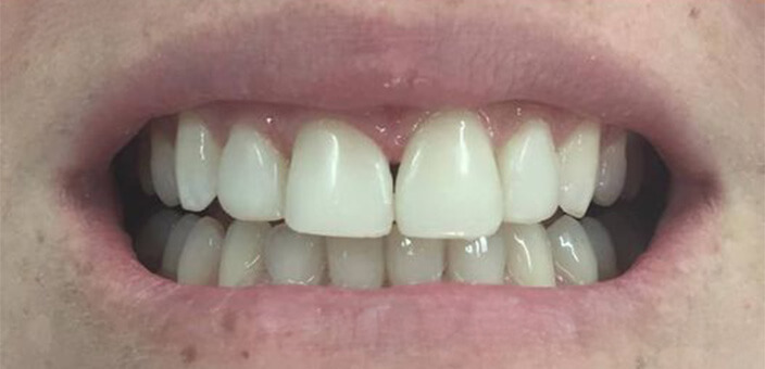 veneers before