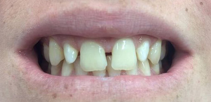 veneers after