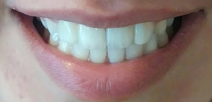 teeth whitening before