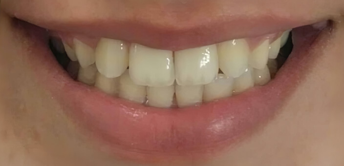 teeth whitening after