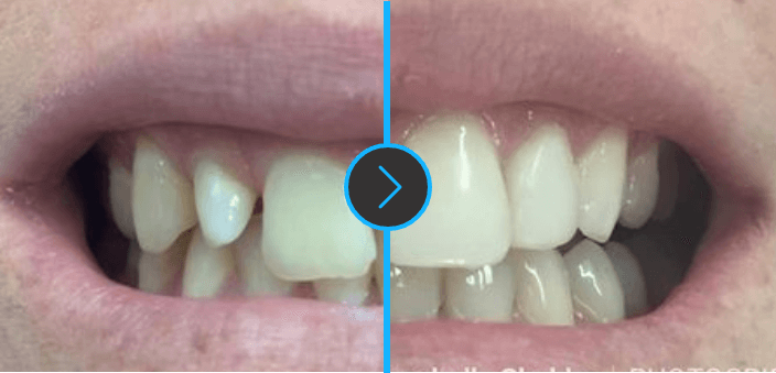 before-and-aafter-veneers-and-smile-makeover