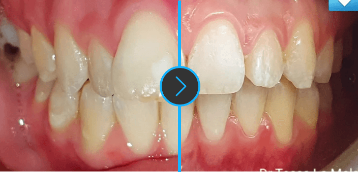 before-and-after-clear-aligners