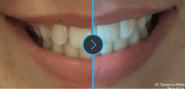before-and-after-teeth-whitening
