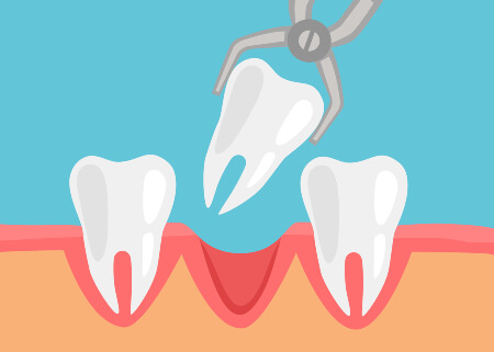 Dental Extractions illustration