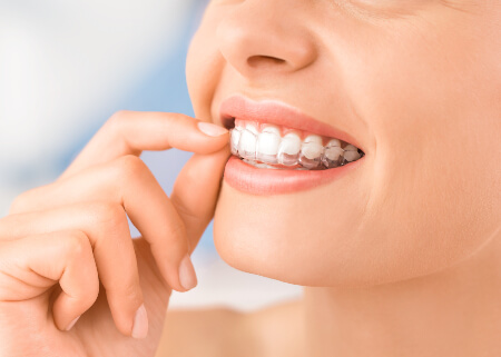 Female fitting Spark Clear Aligners