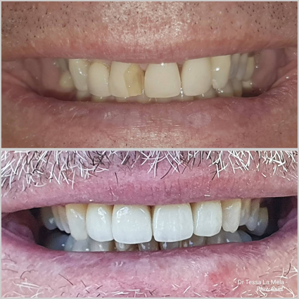 porcelain veneers before and after